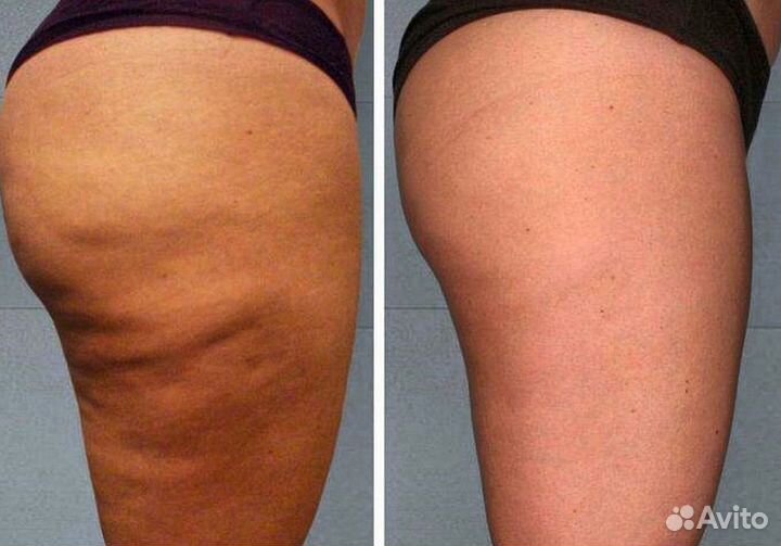 Массаж коррекция фигуры