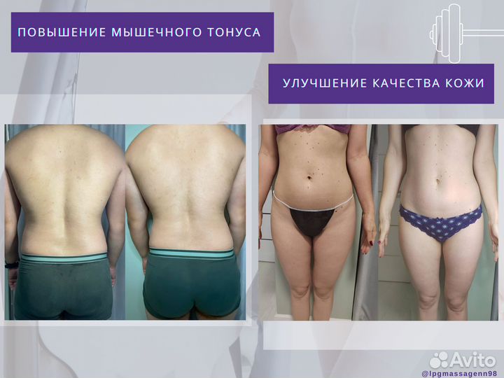 LPG массаж, антицеллюлитный массаж, косметология