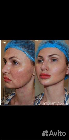 Смас-лифтинг лица