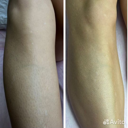 Электроэпиляция Октябрьское поле Щукинская Сокол