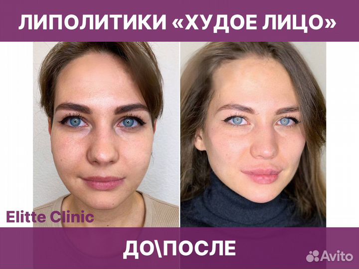 Косметолог худое лицо липолитики