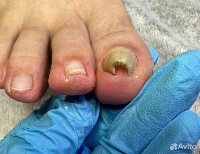 Подолог Педикюр Вросший ноготь Онихолизис