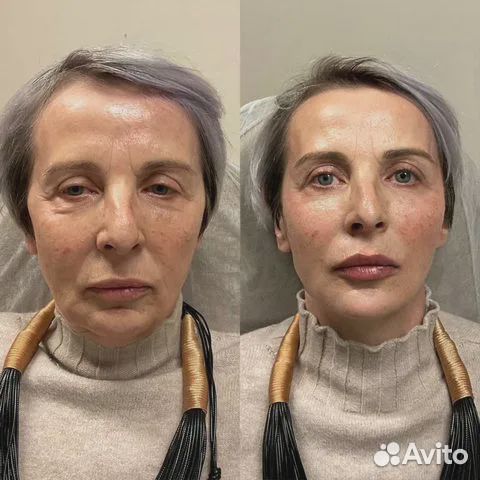 Минус 15 лет за процедуру. СМАС лифтинг