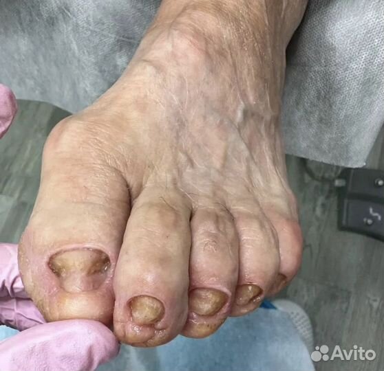 Педикюр для лежачих, уход за ногами на дому