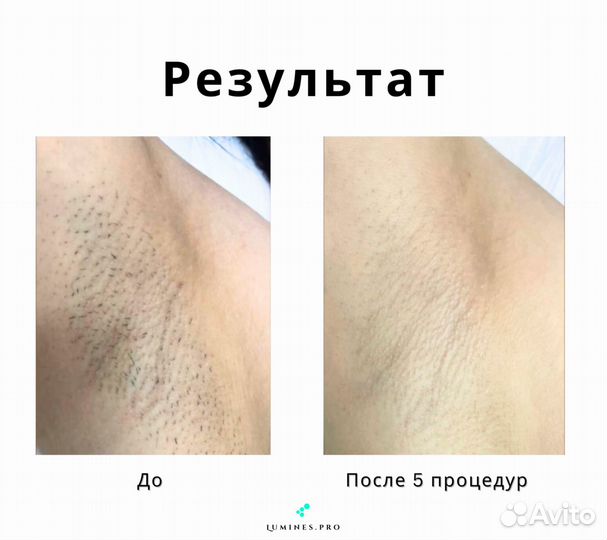 Диодный лазер для эпиляции Lumines. Max’One 1200W