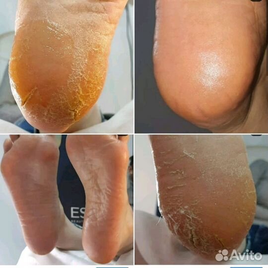 Подолог юмр, педикюр, маникюр, вросший ноготь кс