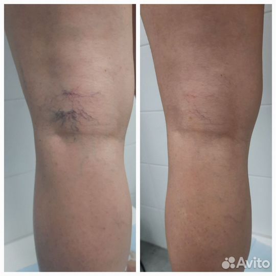 Аппаратный массаж против варикоза