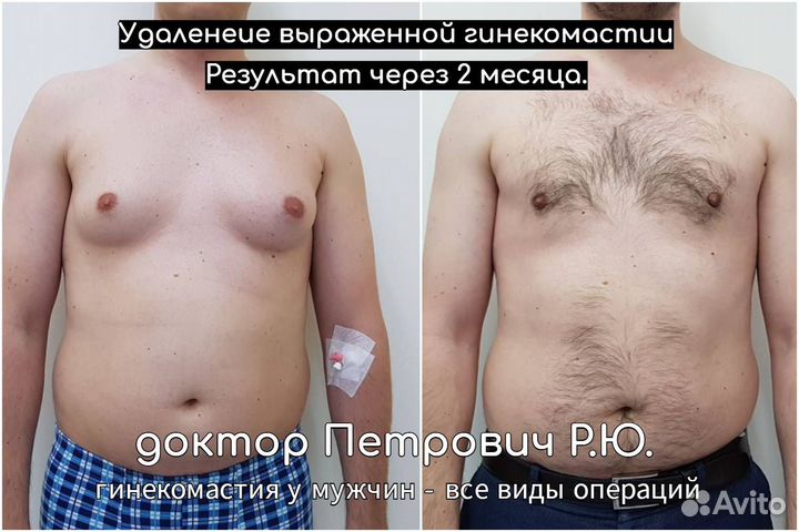 Лечение гинекомастии смешанной формы