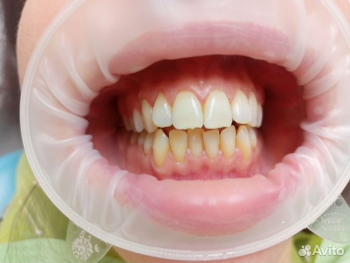 Купон Скидка Виниры, люминиры