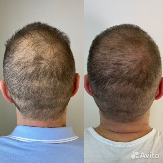 Трихопигментация головы