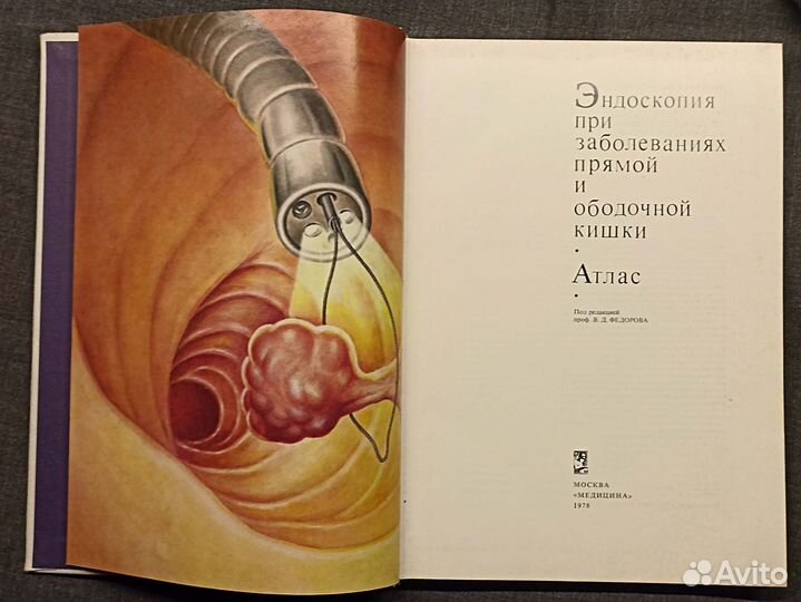 Эндоскопия при заболеваниях прямой и ободочной киш