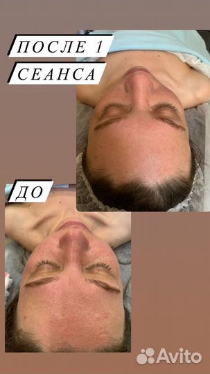 Скульптурный,лимфодренажный,буккальный массаж лица