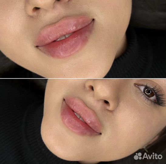 Аугментация губ