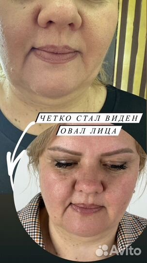 Липолитики по лицу