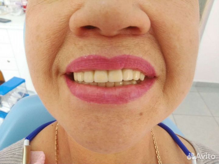 Съёмные протезы, несъёмные. Зубной техник