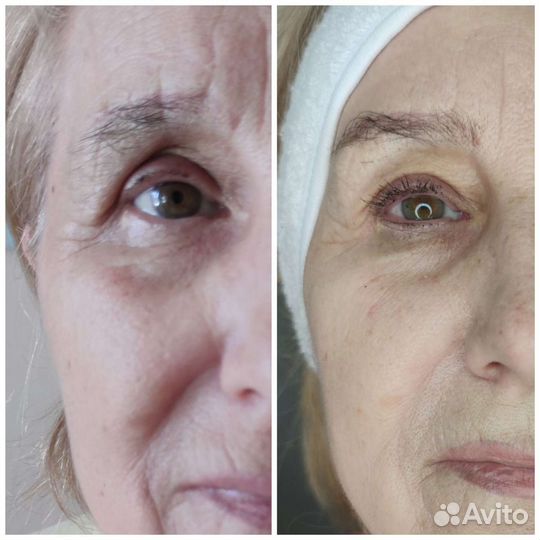 Обучение смас, крио, кавитация, плазма, хис