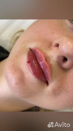 Увеличение губ, ботулинотерапия