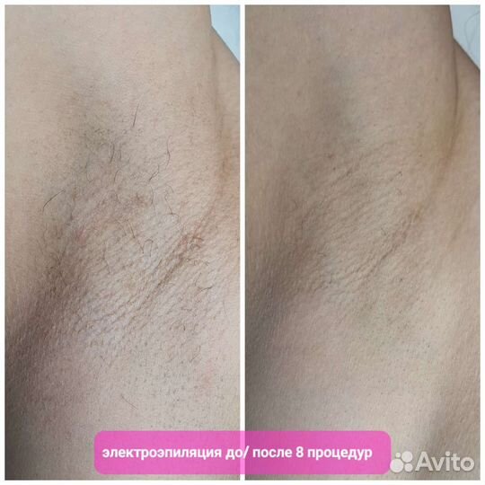 Электроэпиляция