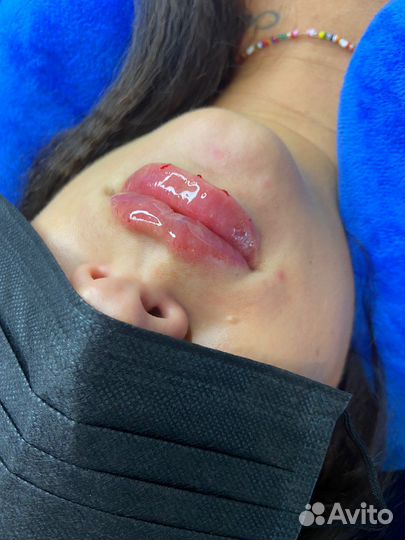 Модель на увеличение губ