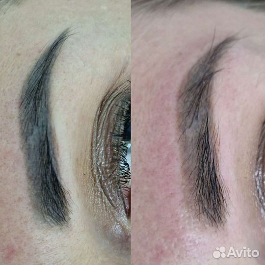 Лазерное удаление татуажа