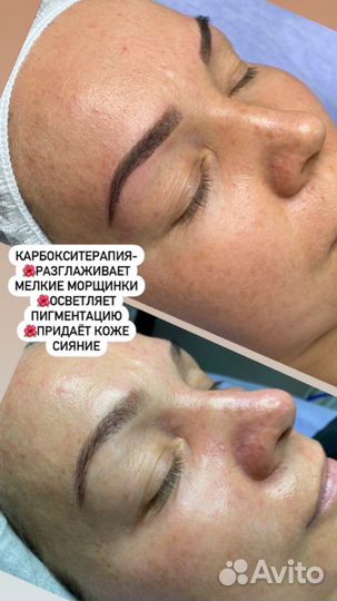 Косметологические процедуры за лицом