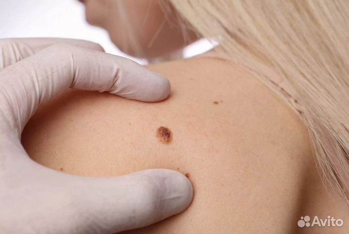 Удaление папиллoм, бородавок, новоoбрaзовaний