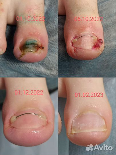 Педикюр.Подолог, установка Титановой нити