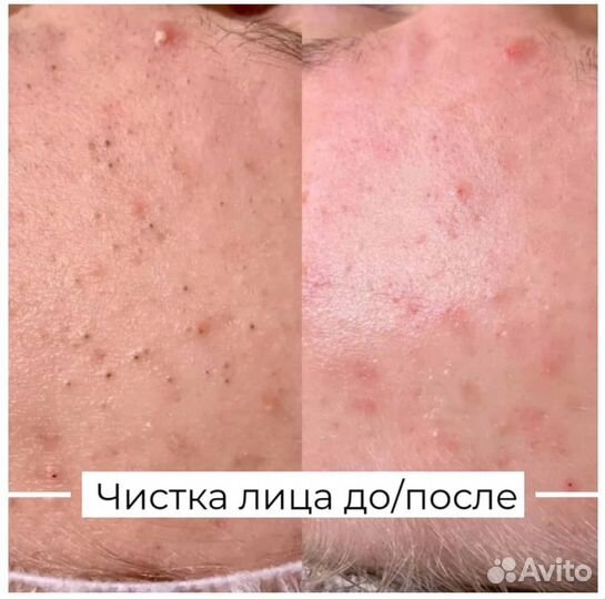 Чистка лица, пилинг, уход, на премиум препаратах