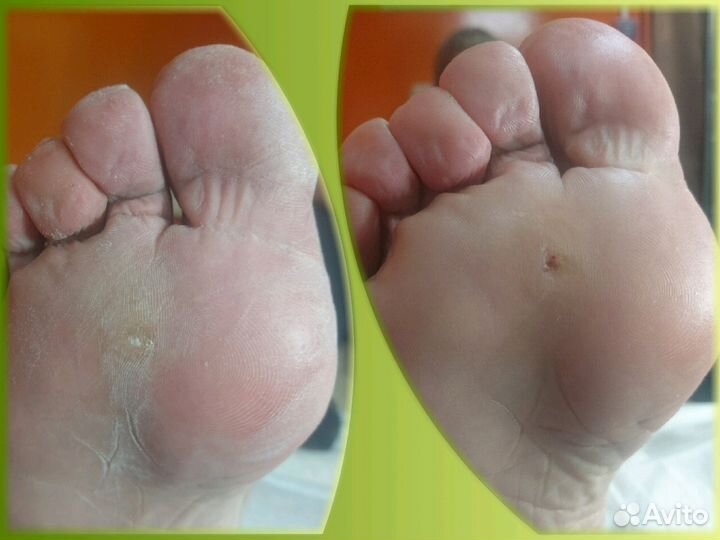 Подологический педикюр Маркс, район