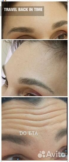 Ботокс для лица