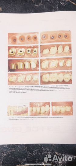 Нулевая утрата кости