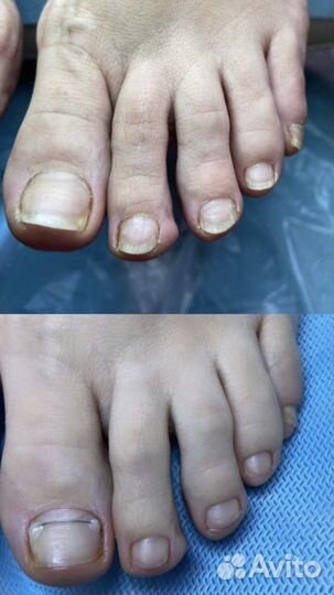 Подолог лечебный педикюр титановая нить грибок