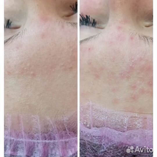 Косметолог чистка лица,пилинг