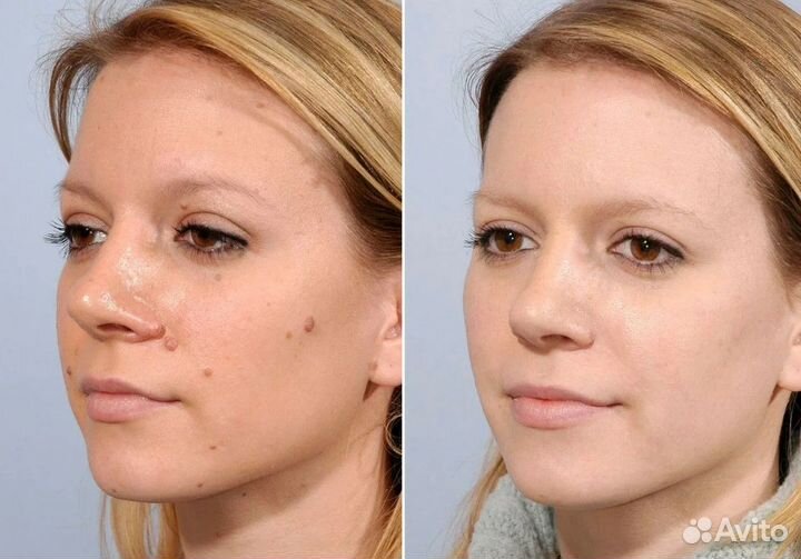 Удaление папиллoм, бородавок, новоoбрaзовaний