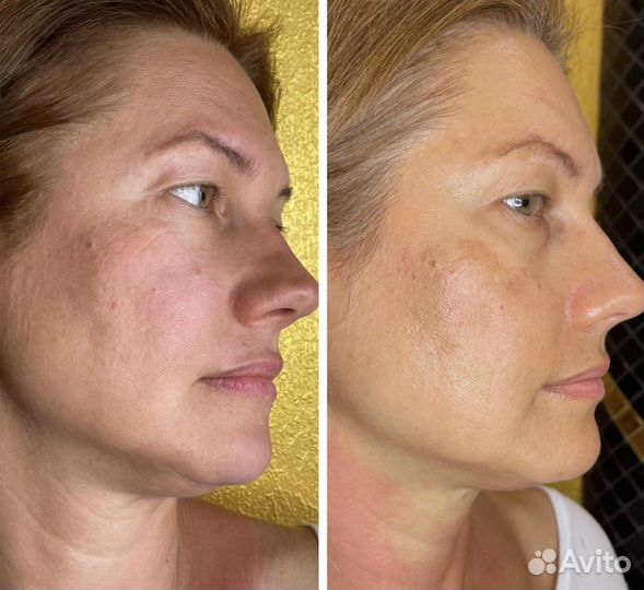 Омоложение холодной плазмой