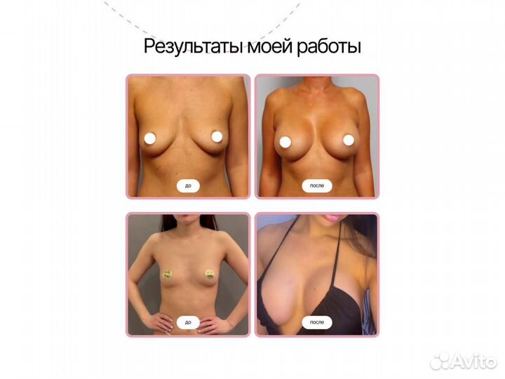 Увеличение груди