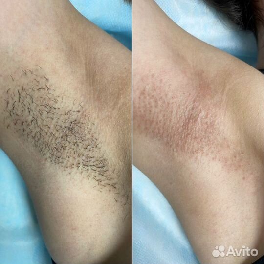 Депиляция/электроэпиляция