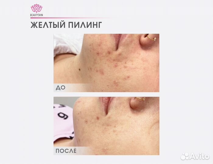 Желтый пилинг