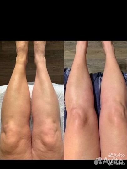 Криолиполиз Безопасное похудение Геленджик