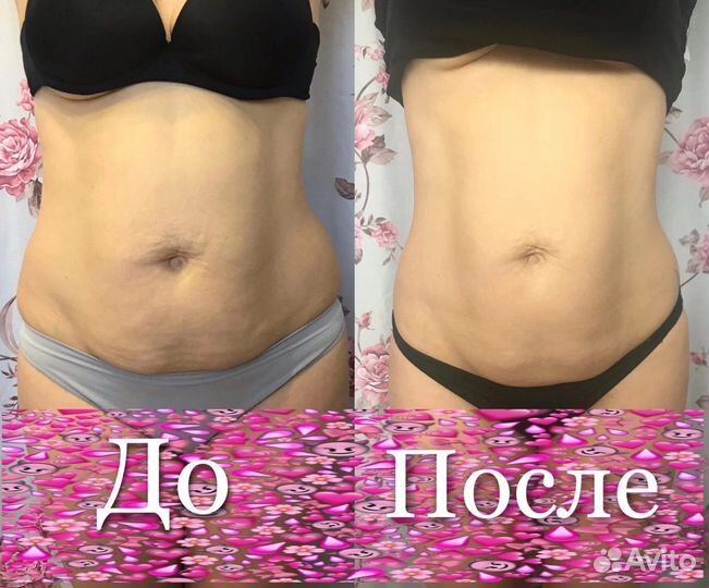 LPG, кавитация, вакуумный, rf лица и тела