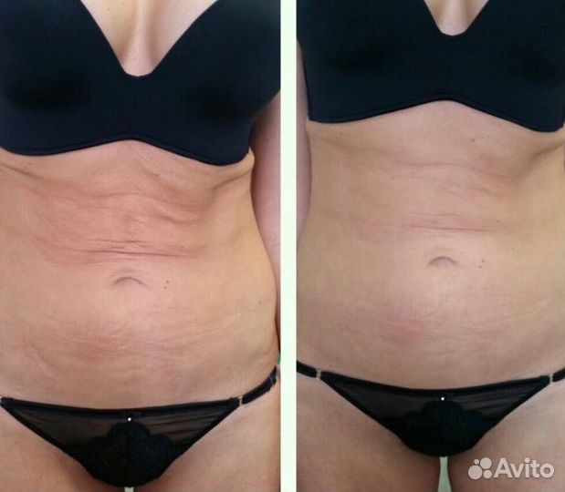 Липосакция без операции
