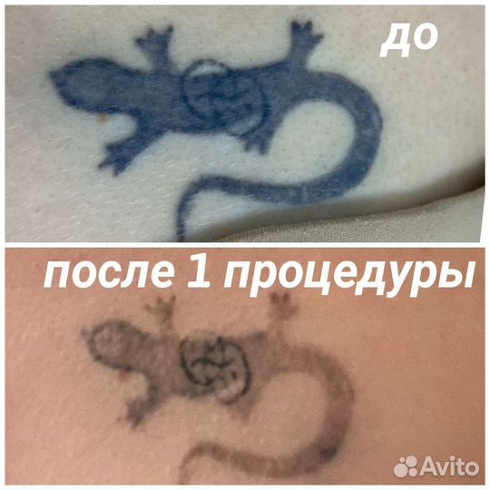 Удаление тату и татуажа