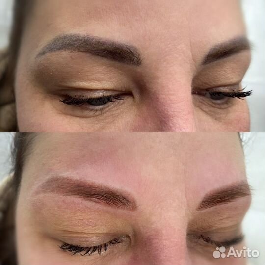 Лазерное удаление тату и татуажа