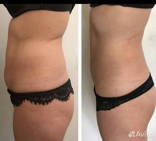 Плазмолифтинг, прессотерапия