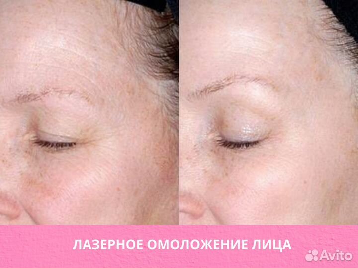 Обучение аппаратной косметологии с нуля