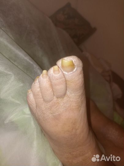 Медицинский педикюр на дому