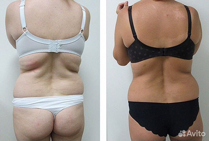 LPG аппаратный массаж