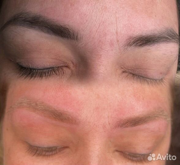 Удаление Татуажа и тату