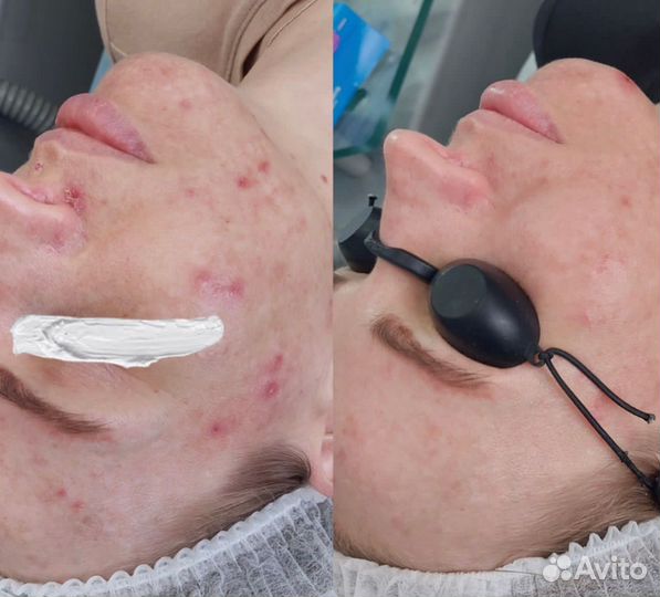 Фототерапия на аппарате М22