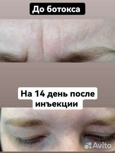 Ботокс, липолитики, мезотерапия, биоревитализация